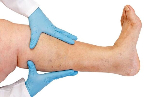 vene varicose sulle gambe